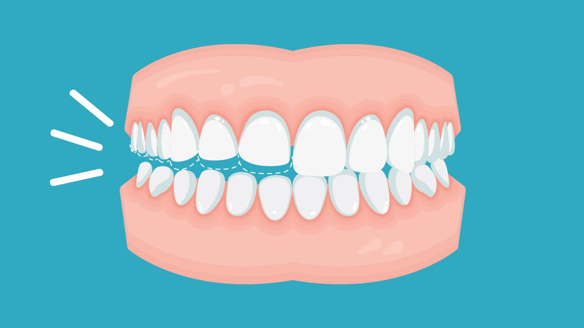 Bruxismo pode ganhar campanha de conscientização no Amazonas