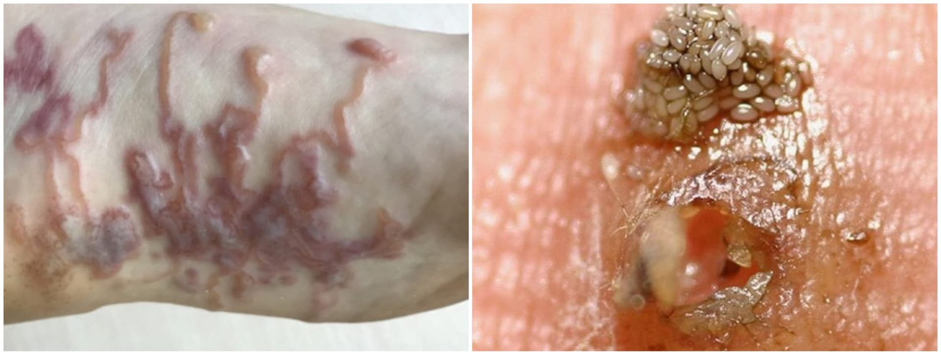 Tá com coceira no pé? Diferenças entre bicho-de-pé e bicho geográfico são cruciais no tratamento