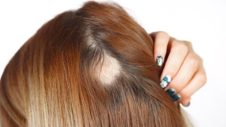 Alopecia: saiba mais sobre doença capilar de Virginia Fonseca e como tratar