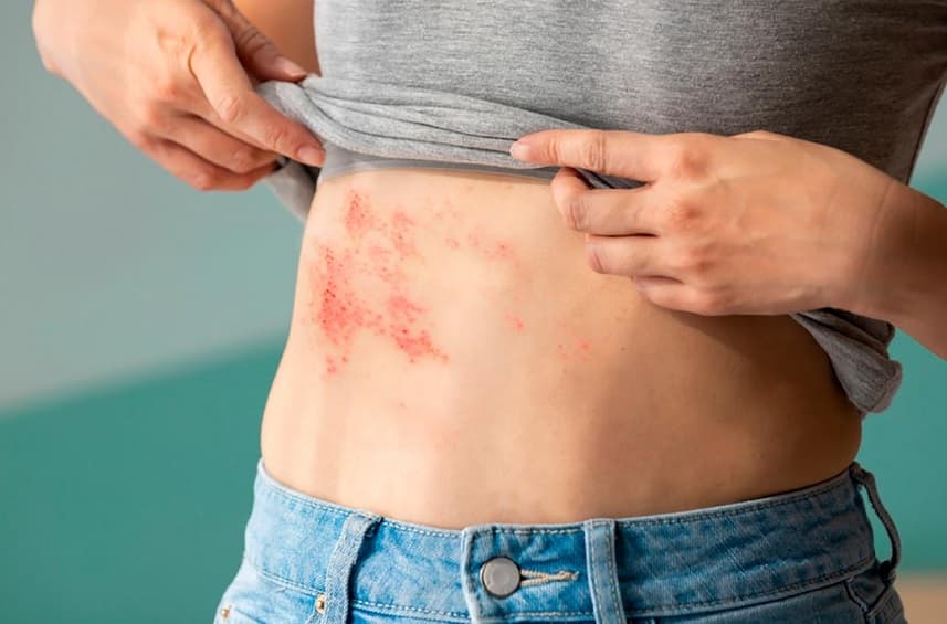 Herpes-zóster: Especialista fala sobre doença que afeta a pele e pode atingir os nervos