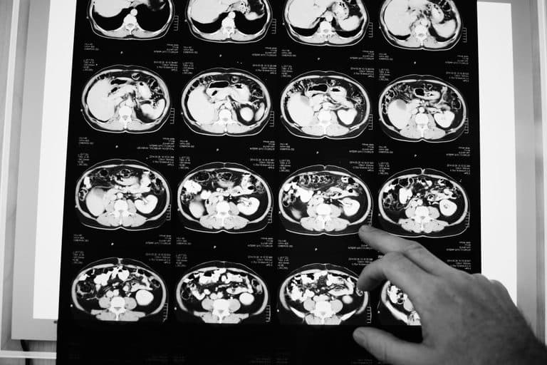 Anvisa aprova novo medicamento para tratar câncer colorretal metastático; veja como funciona