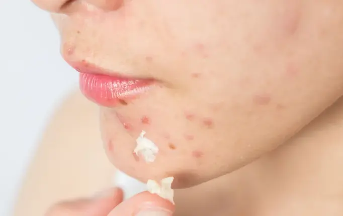 Jovens usam TikTok para buscar informações sobre acne