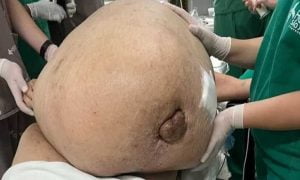 Mulher é operada no RJ para retirar tumor de 46 kg