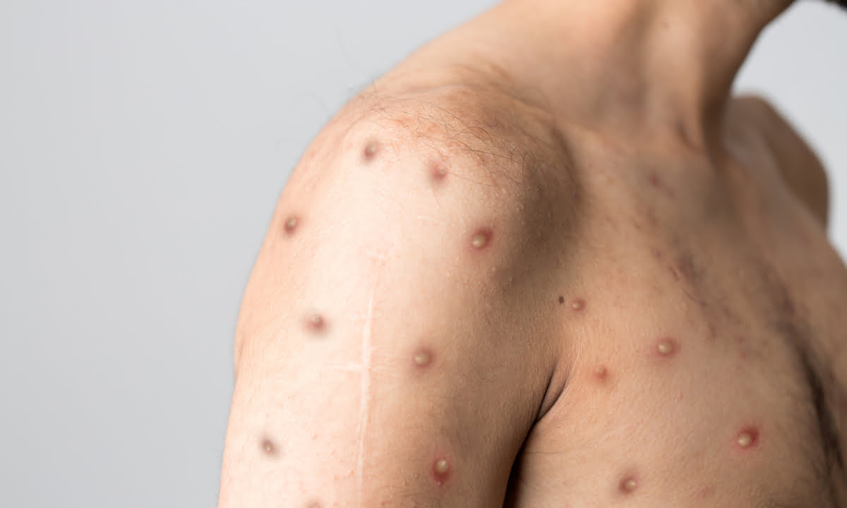Mais de 30 casos de Mpox são registrados no Amazonas; saiba como prevenir