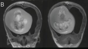 Veja imagens: Feto é retirado de cérebro de menina de 1 ano