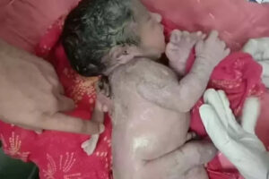 Bebê nasce com 3ª mão nas costas na Índia