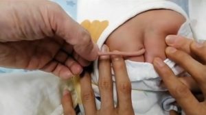 "Bebê Goku"? China registra caso de recém-nascido com cauda de 10 centímetros