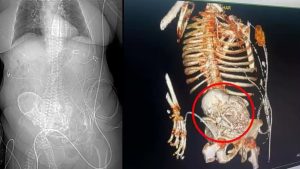 INCRÍVEL: Idosa morre durante retirada de "bebê de pedra" que ela carregou por 50 anos