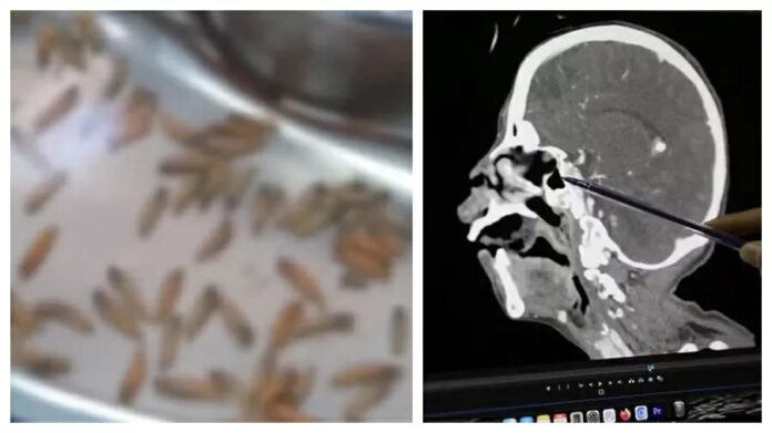 Médicos retiram 150 larvas de mosca da boca de uma mulher, no Peru