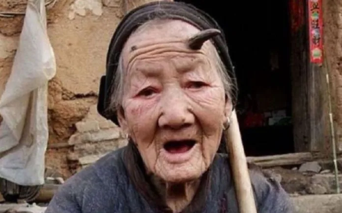 Um caso bizarro chamou atenção de internautas após uma idosa chinesa identificada como Chen, de 107 anos, mostrar um chifre